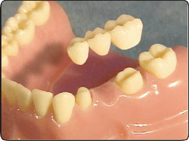 Implant bridge